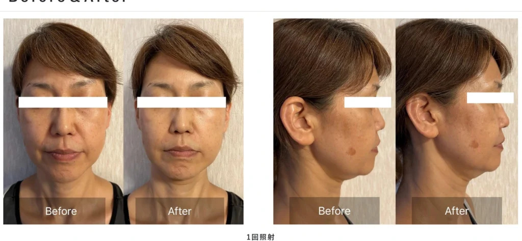 BIITO PRIME使用例 顔のBefore & After(1回照射)