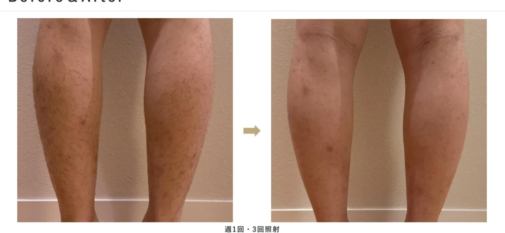 BIITO PRIME使用例 脚のBefore & After(週1回・3回照射)