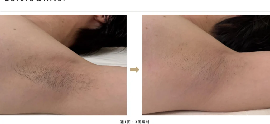 BIITO PRIME使用例 ワキのBefore & After(週1回・3回照射)